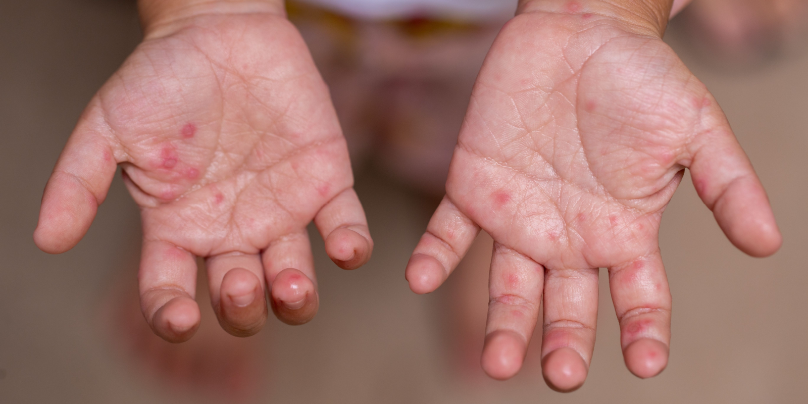 Antibiotic For Hand Foot And Mouth Disease At Ruth Sapp Blog