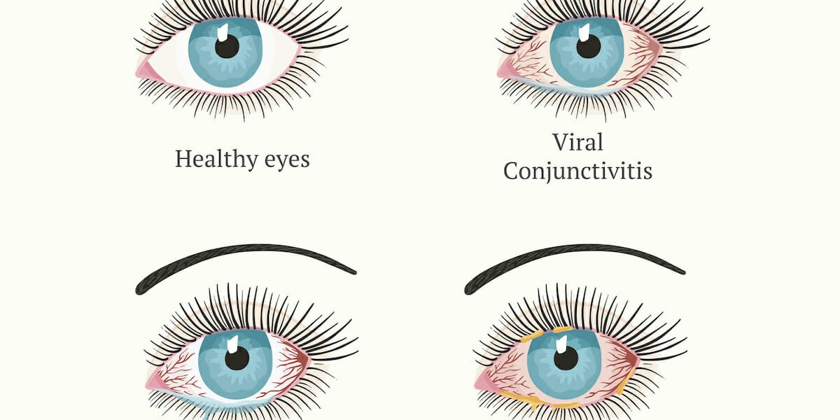 How Long Does Pink Eye Last